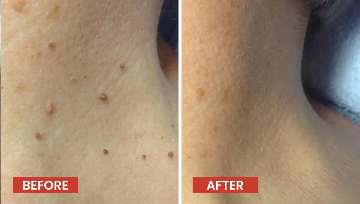 Derma-Smooth-Skin-Tag-Removal-Patches-3